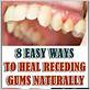 heal gums quickly