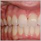 healthy gums bottom teeth