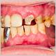 heroin teeth gum disease