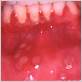 herpes 1 gum disease