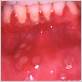 herpes simplex gum disease