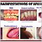 hiv kissing gum disease