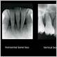 horizontal vs vertical bone loss