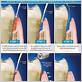 how deep can laser go with gum disease surgy