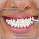 how do dentists treat gingivitis
