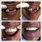 how do i care for dental implants