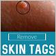 how do i remove a skin tag with dental floss