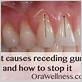 how do i stop my gum disease