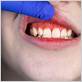 how does nicotine cause gum disease