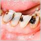 how does plaque cause tooth decay and gum disease