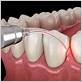 how effective is laser treatment for gum disease
