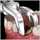 how long after tooth extraction can i use a waterpik