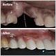 how long before chewing after a dental bone graft