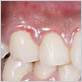 how long does it take swollen gums to go down