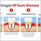 how much is a gum disease treatment