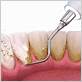 how scaling and root planing can treat mild gum disease