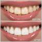 how to best whiten teeth