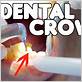 how to clean a crown tooth