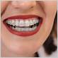how to cure gum disease with braces