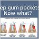 how to fix deep pockets in gums