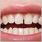 how to fix gaps in teeth caused by gum disease