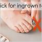 how to fix ingrown toenail with dental floss