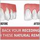 how to fix loose teeth from gum disease naturally