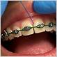 how to floss with braces with threader