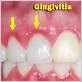 how to get gingivitis