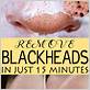 how to get rid of blackheads with toothbrush