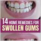 how to get rid of inflamed gums fast
