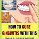 how to heal gingivitis at home