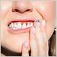 how to live with gum disease