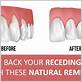 how to prevent gum disease if gums are receding