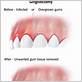 how to remove infection from gums