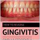 how to reverse gingivitis fast