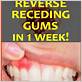 how to reverse gum disease fast