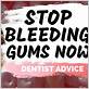 how to stop gums bleeding