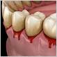 how to treat gum disease bleeding gums