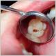 how to treat tooth decay and gum disease