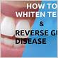 how to whiten teeth with gum disease