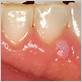 hpv gum disease