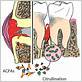 http hub.jhu.edu 2016 12 16 bacterial-link-rheumatoid-arthritis-gum-disease