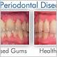 hudson gum disease treatment