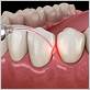 hygienist treatment for gum disease
