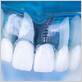 if you have gum disease can you have implants