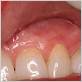 infected cut on gums