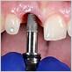 infection dental implant