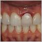 inflamed gums after crown placement