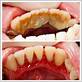 inflamed gums after dental cleaning
